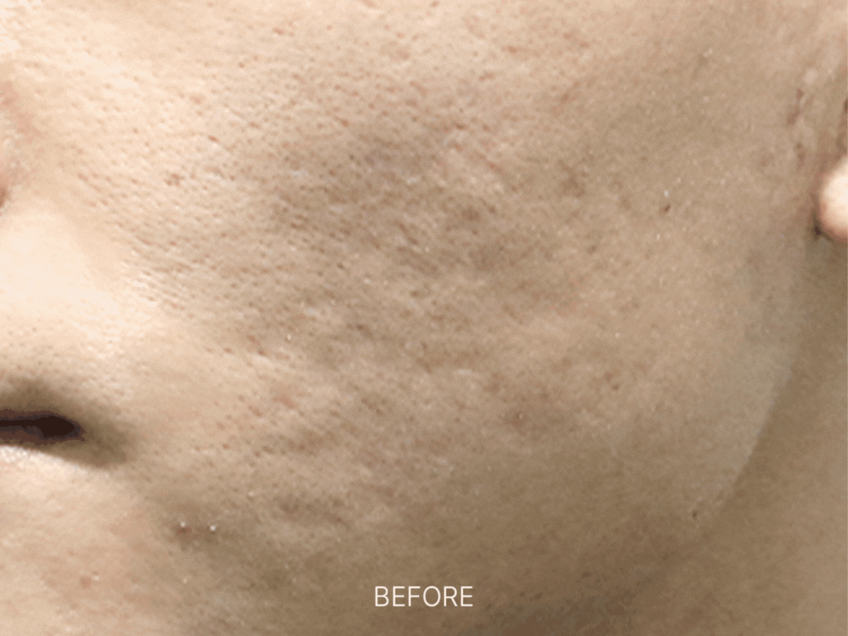 로담 치료 프로세스